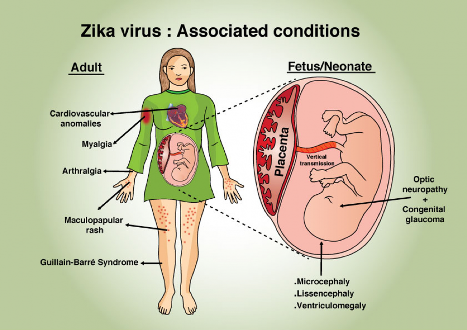 Ната зика. Вирус Зика структура. Лихорадка Зика патогенез.